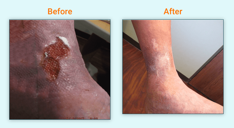 Before and After Lower Extremity Wound Treatment