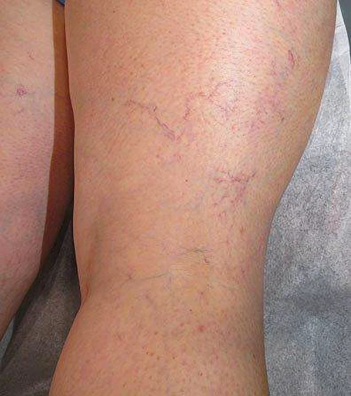 Spider Veins